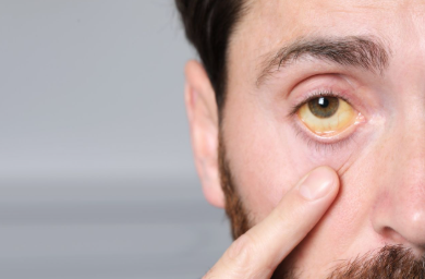 Jaundice Jaundice