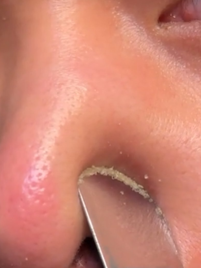 6 effective ways to get rid of stubborn whiteheads forever.